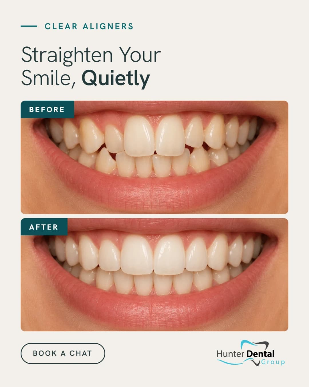 Hunter Dental Group clear aligner social media creative.